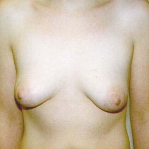 Breast-Augmentation-18 | Before Breast Augmentation 2