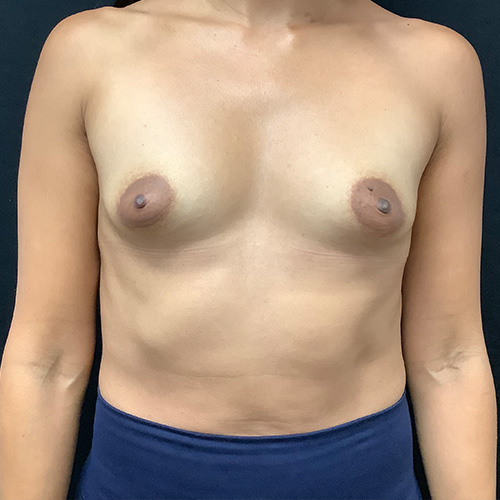 Breast-Augmentation-Patient-23 | Before Breast Augmentation 2
