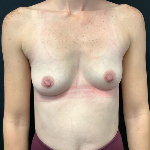 Breast-Augmentation-Patient-24 | Before Breast Augmentation 2