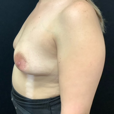 Breast-Augmentation-Patient-27 | Before Breast Augmentation