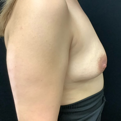 Breast-Augmentation-Patient-27 | Before Breast Augmentation 3