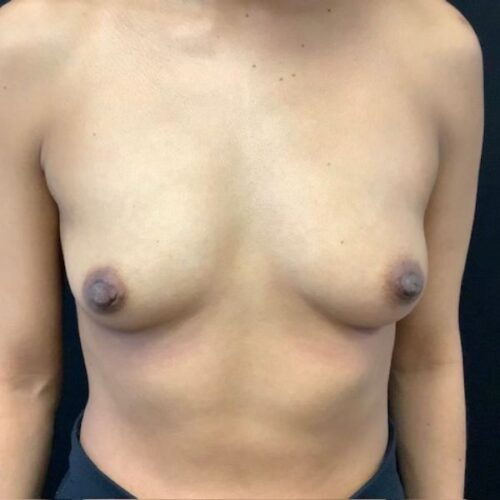 Breast-Augmentation-Patient-29 | Before Breast Augmentation 2