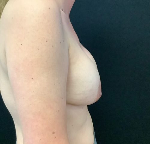 Breast-Implant-Removal-W-Lift-Patient-03 | Before Breast Implant Removal W Lift