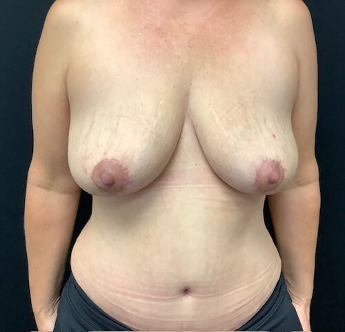 Breast-Implant-Removal-W-Lift-Patient-04 | After Breast Implant Removal W Lift