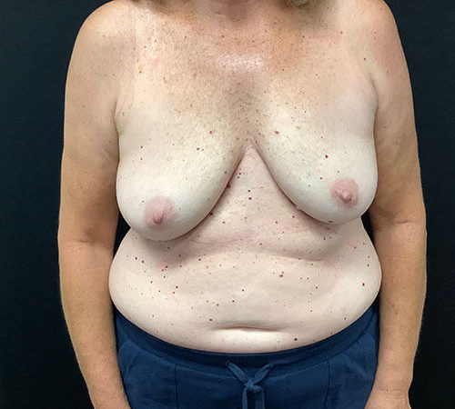 Breast-Implant-Removal-02 | After Breast Implant Removal