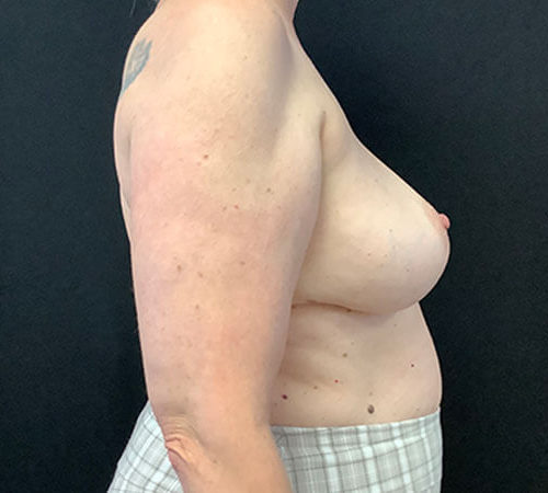 Breast-Implant-Removal-03 | After Breast Implant Removal