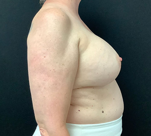 Breast-Implant-Removal-03 | Before Breast Implant Removal