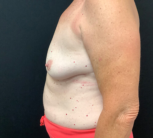 Breast-Implant-Removal-04 | After Breast Implant Removal