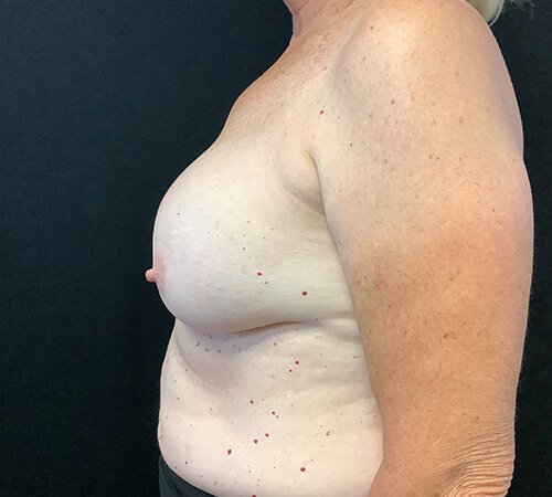 Breast-Implant-Removal-04 | Before Breast Implant Removal