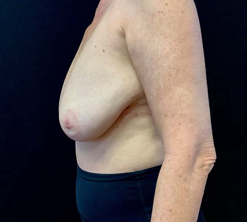 Breast-Implant-Removal-05 | After Breast Implant Removal