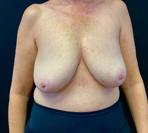 Breast-Implant-Removal-05 | After Breast Implant Removal 2