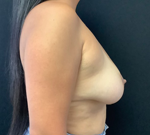 Breast-Implant-Removal-06 | After Breast Implant Removal