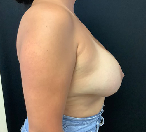 Breast-Implant-Removal-06 | Before Breast Implant Removal