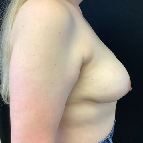 Breast-Implant-Removal-08 | After Breast Implant Removal