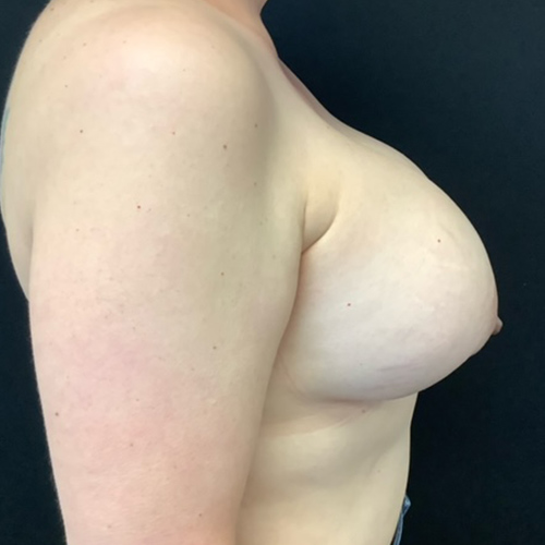 Breast-Implant-Removal-08 | Before Breast Implant Removal