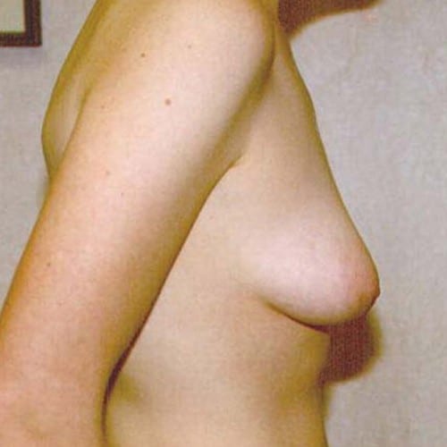Breast-Lift-02 | Before Breast Lift