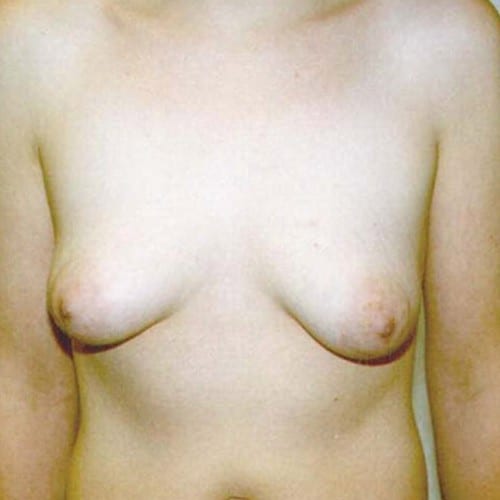 Breast-Lift-02 | Before Breast Lift 2