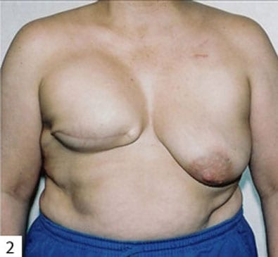 Breast-Reconstruction-01 | After Breast Reconstruction 2