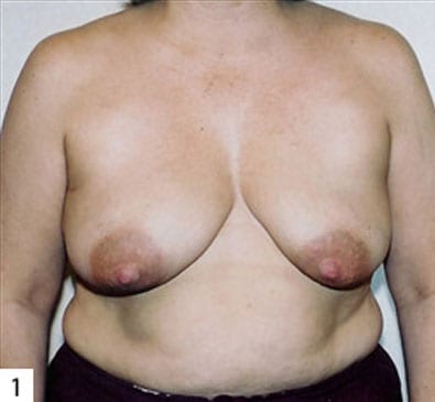 Breast-Reconstruction-01 | Before Breast Reconstruction 2
