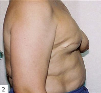 Breast-Reconstruction-01 | After Breast Reconstruction 3