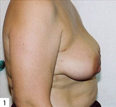 Breast-Reconstruction-01 | Before Breast Reconstruction 3