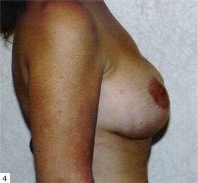 Breast-Reconstruction-02 | After Breast Reconstruction