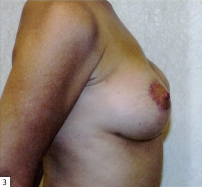 Breast-Reconstruction-02 | Before Breast Reconstruction