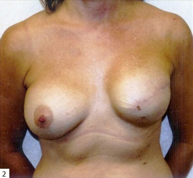 Breast-Reconstruction-02 | Before Breast Reconstruction 2