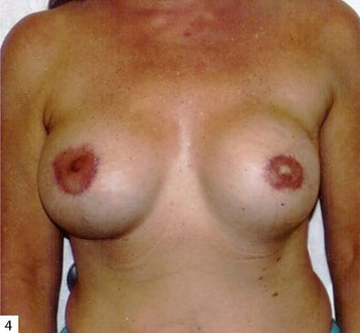 Breast-Reconstruction-02 | After Breast Reconstruction 3