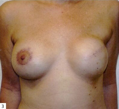 Breast-Reconstruction-02 | Before Breast Reconstruction 3