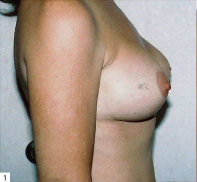 Breast-Reconstruction-02 | Before Breast Reconstruction 4