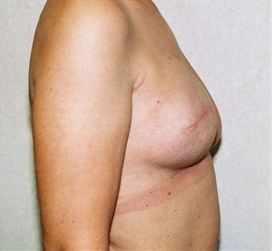 Breast-Reconstruction-03 | After Breast Reconstruction