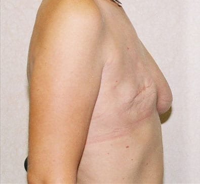 Breast-Reconstruction-03 | Before Breast Reconstruction