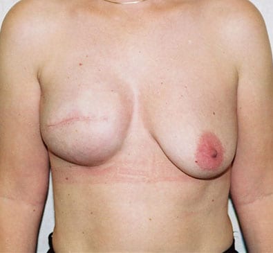 Breast-Reconstruction-03 | After Breast Reconstruction 2