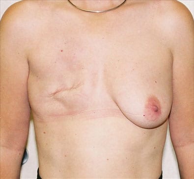 Breast-Reconstruction-03 | Before Breast Reconstruction 2