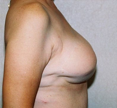 Breast-Reconstruction-04 | After Breast Reconstruction
