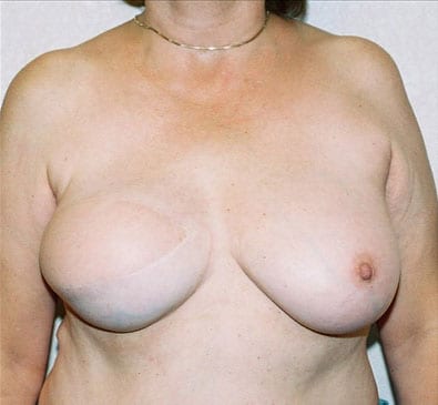 Breast-Reconstruction-04 | After Breast Reconstruction 2