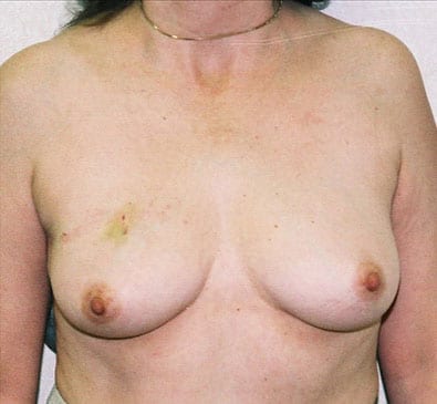 Breast-Reconstruction-04 | Before Breast Reconstruction 2