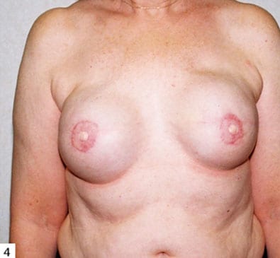 Breast-Reconstruction-05 | After Breast Reconstruction