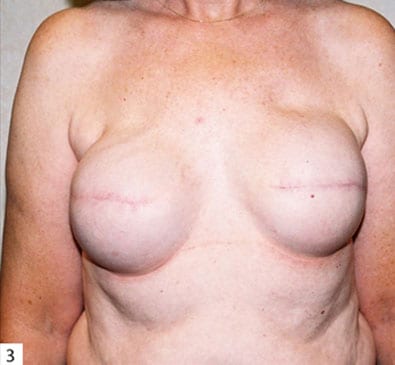 Breast-Reconstruction-05 | Before Breast Reconstruction