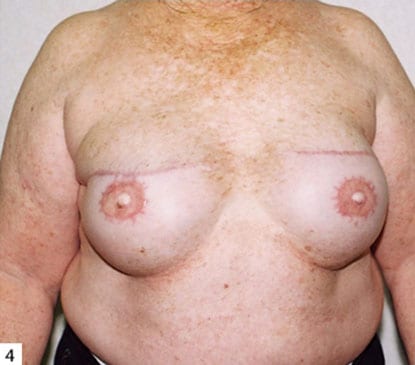 Breast-Reconstruction-06 | After Breast Reconstruction