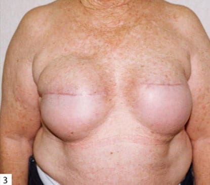 Breast-Reconstruction-06 | Before Breast Reconstruction
