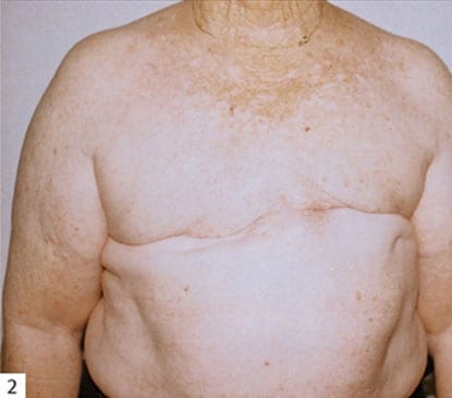 Breast-Reconstruction-06 | After Breast Reconstruction 2