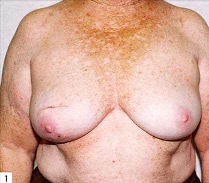 Breast-Reconstruction-06 | Before Breast Reconstruction 2