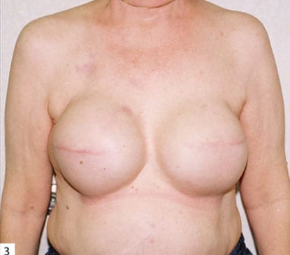 Breast-Reconstruction-07 | Before Breast Reconstruction