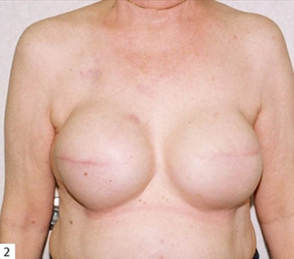 Breast-Reconstruction-07 | After Breast Reconstruction 2