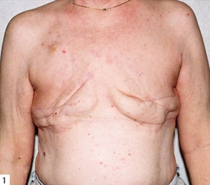 Breast-Reconstruction-07 | Before Breast Reconstruction 2