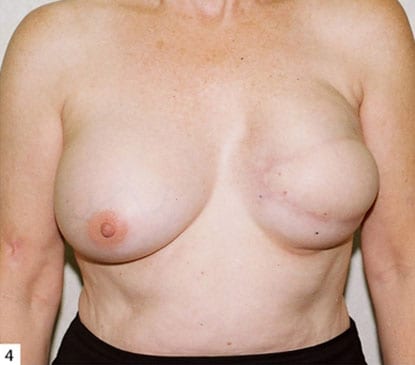 Breast-Reconstruction-08 | After Breast Reconstruction