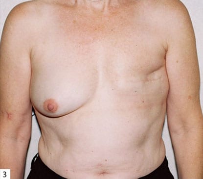 Breast-Reconstruction-08 | Before Breast Reconstruction