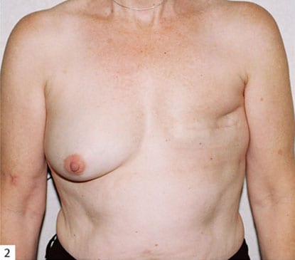 Breast-Reconstruction-08 | After Breast Reconstruction 2